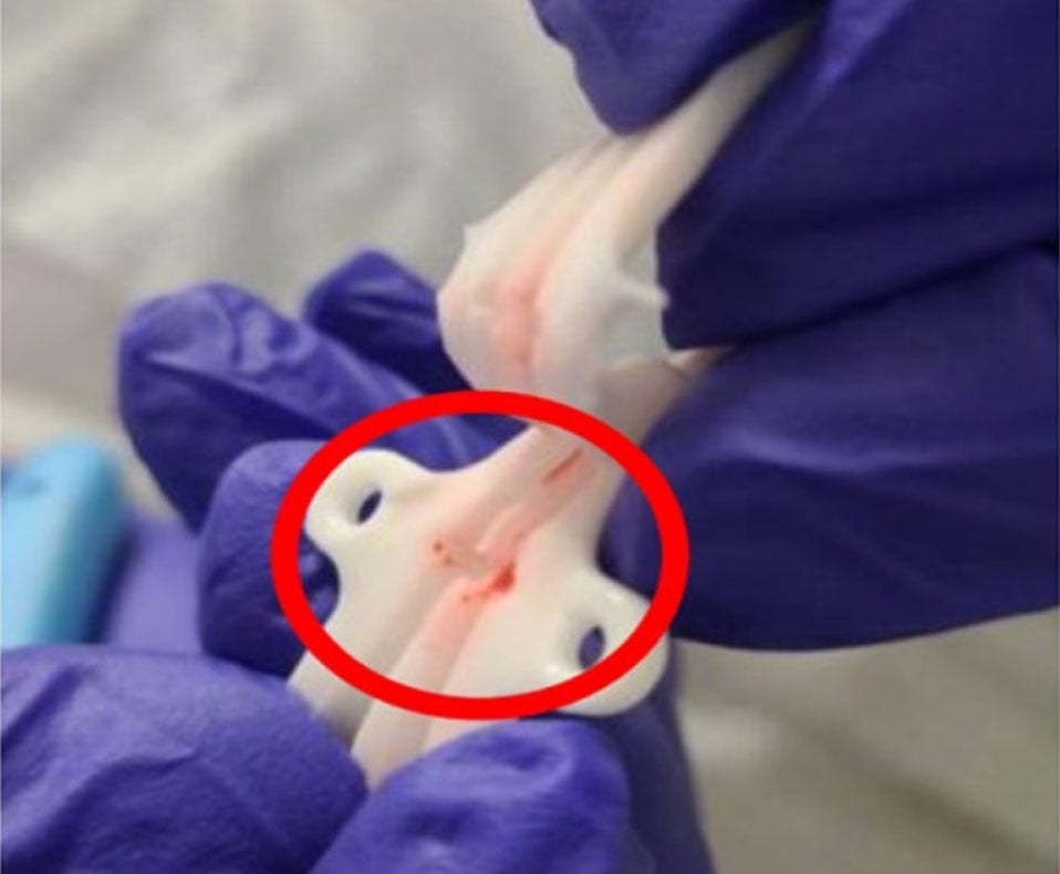 RECALL: Palindrome and Mahurkar Hemodialysis Catheters and How to Find Alternative Products